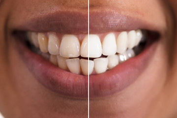Woman Teeth Before And After Whitening