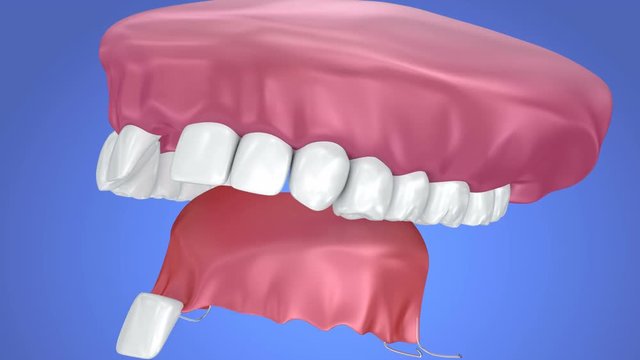 Single Missing Tooth - Removable partial denture. 3d animation