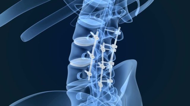 Spinal fixation system - titanium bracket. X-Ray animation view .