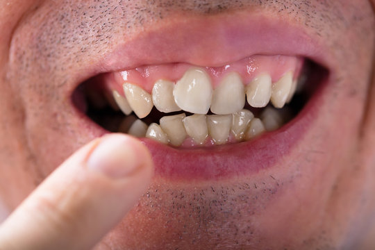 Man Showing His Teeth