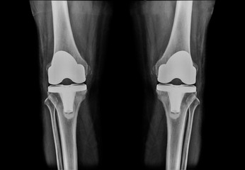 x-ray image total knee athoplasty