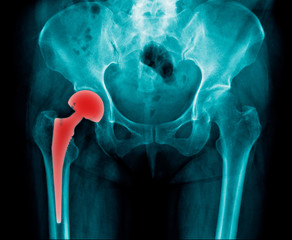 x-ray image total hip arthroplasty, hip replacement 