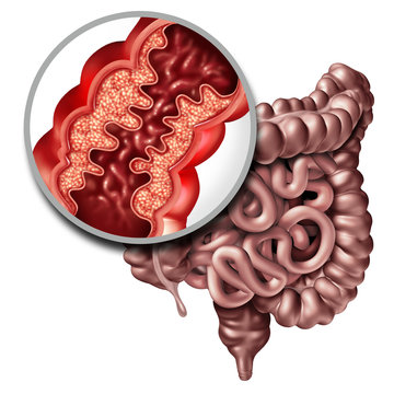 Crohn's Disease