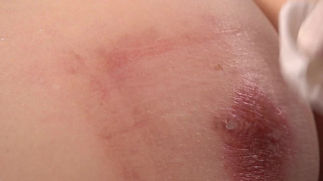 Close-up of doctor examining skin inflammation