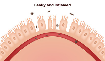 Celiac disease Small intestine lining damage. good and damaged villi . leaky gut progression