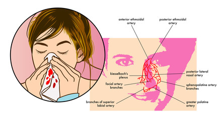 vector medical illustration of the symptoms of epistaxis (nosebleed)