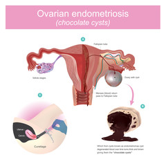 Ovarian lesions may trap menstruating blood, which from cysts known as endometriosis Degenerated blood over time turns thick and brown giving them the name chocolate cysts.