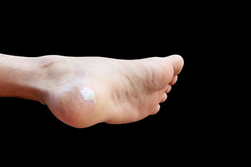 close up pain foot corn isolated on black background with clipping path