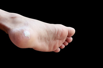 close up pain foot corn isolated on black background with clipping path