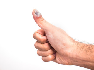 Male hand showing thumbs up sign with his bruise thumbnail from accident