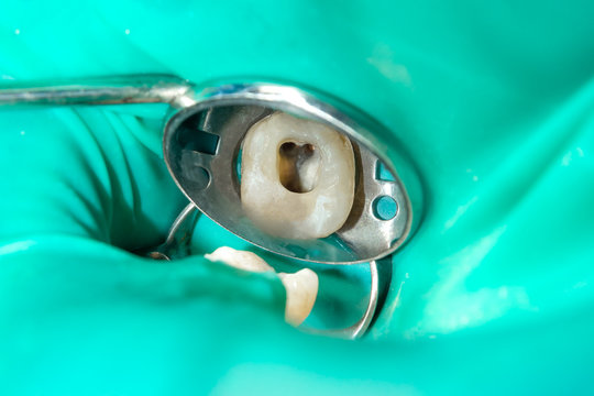 close-up of a human rotten carious tooth at the treatment stage in a dental clinic