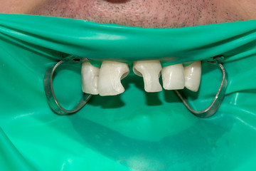 close-up of a human rotten carious tooth at the treatment stage in a dental clinic