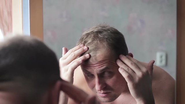 Man upset by hair loss or dandruff