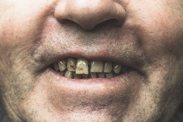 Smiling mouth of smoker with yellow crooked teeth and tartar
