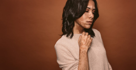 Vitiligo affected young woman
