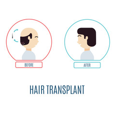 Fototapeta premium Hair transplantation infographics. Patient with alopecia before and after the procedure. Hair loss medical treatment. Faceless man, no identity concept. Vector illustration for transplantation clinics