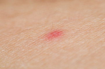 macro shot on human skin with red spoted from mosquito sucking blood. arm skin texture.