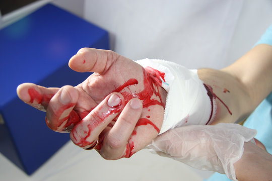 Mann blutet an der Hand Arm nach Angriff mit Messer - Man bleeds beeing attacked with knife