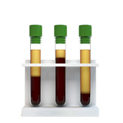 Blood centrifugations show normal and abnormal level of red blood cells. Hematocrit test concept. 