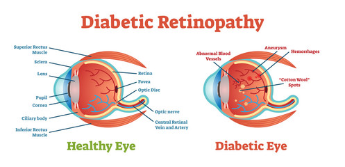 Diabetic Retinopathy vector illustration diagram, anatomical scheme. 