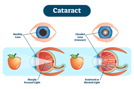 Cataract vector illustration diagram, anatomical scheme. 
