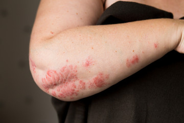The problem with many people - eczema on hand. Dark background. Man itchind skin.