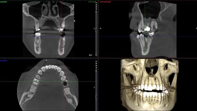 real life MRI scan of man jaws for stomatology dentist research new quality medical science dental footage animation screen