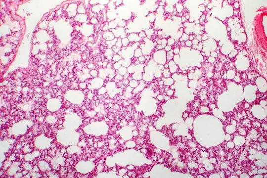 Histology of human lung tissue. Light micrograph showing alveoli, hematoxylin and eosin staining