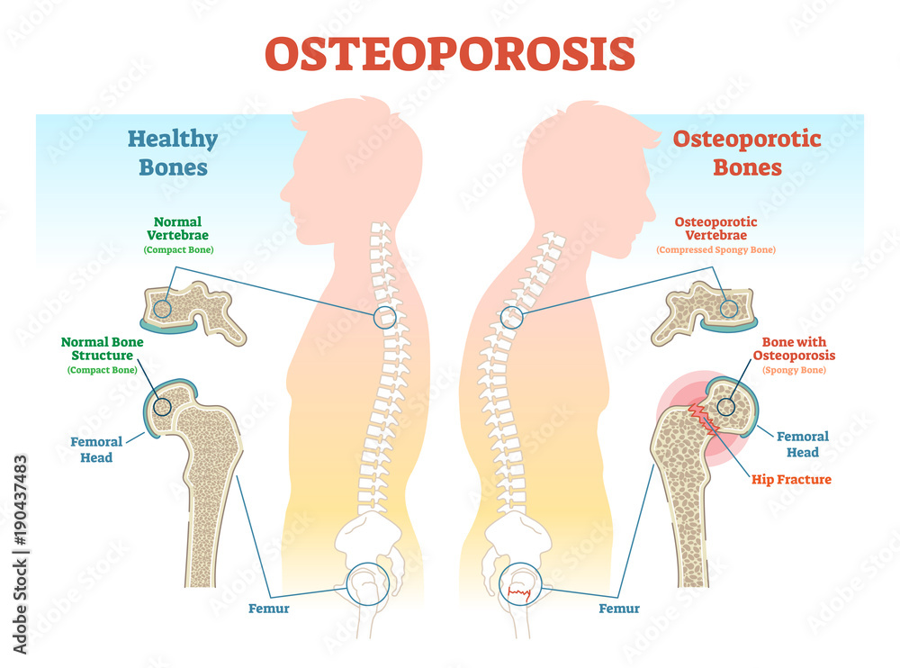 Sticker Osteoporosis examples vector illustration diagram with bone density. 