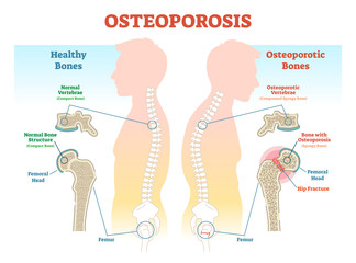 Osteoporosis examples vector illustration diagram with bone density.  - obrazy, fototapety, plakaty