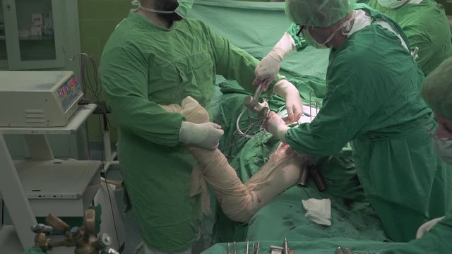 Surgeon team with female medic support using surgical tools, heavy mallet and nail to operating patient trauma, total hip replacement surgery procedure at operation room, crane shot, close up, indoor