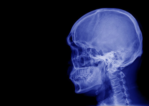 X-ray image of side view asian skull black and white