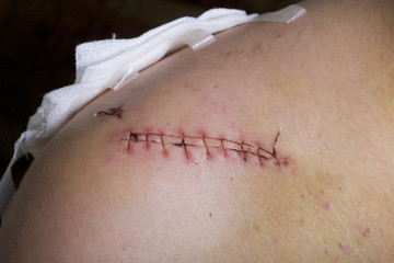 A man with a collarbone injury. The operating seam is visible. The gauze swab is removed.