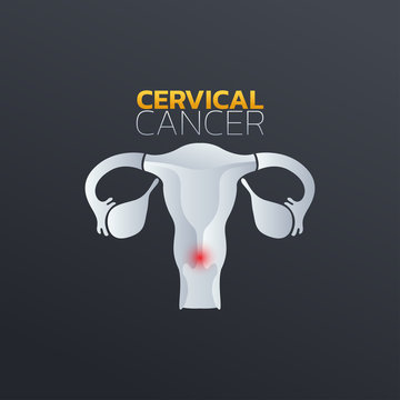 Cervical Cancer Icon Design, Infographic Health. Vector Illustration.