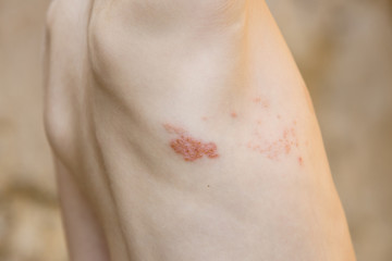Symptom of herpes zoster (shingles)