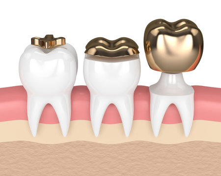 3d render of teeth with different types of dental gold filling
