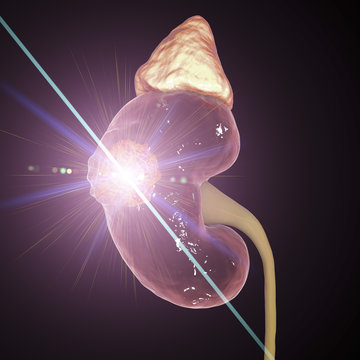 Treatment of kidney cancer with laser, conceptual image. 3D illustration. Concept of laserotherapy of tumors