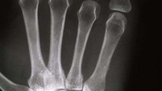 X-rays of hands of an adult man with visible damage ,shot moving by dolly
