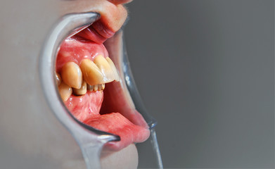 Mouth with  prosthetic  teeth
