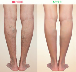 Treatment of varicose before and after. Varicose veins on the legs.