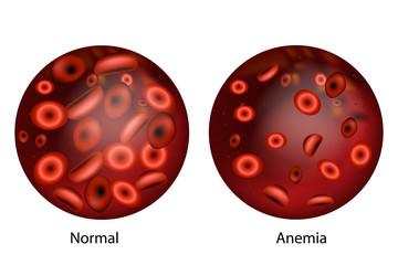 Iron deficiency anemia.The difference of Anemia amount of red blood cell and normal.  - obrazy, fototapety, plakaty