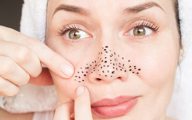 girl with problem skin. pimples on the face