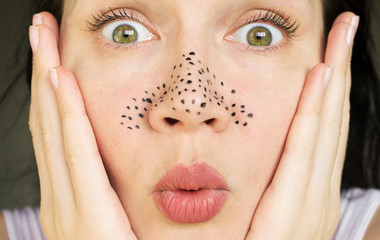 girl with problem skin. pimples on the face