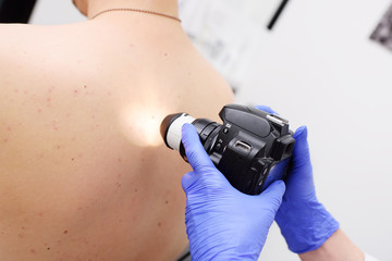 Method of dermatoscopy of skin lesions and moles. Preventing Melanoma and Skin Cancer