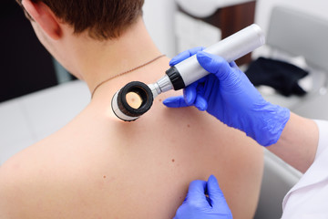 the doctor dermatologist examines birthmarks and birthmarks of the patient with a dermatoscope. Preventive maintenance of a melanoma - obrazy, fototapety, plakaty