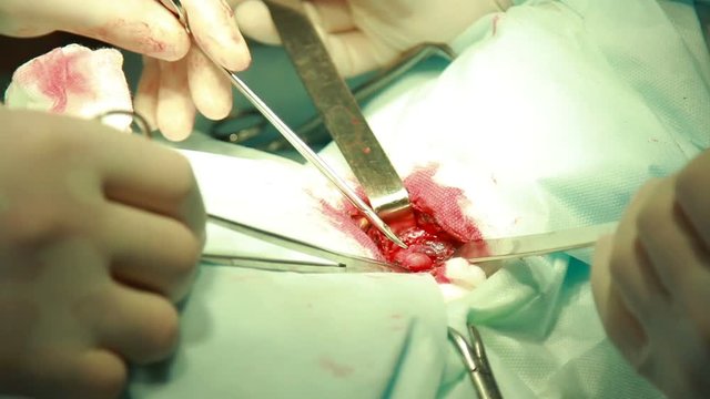 real surgery team operating throat adenoma close up