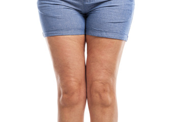 Fat and cellulite on the legs.