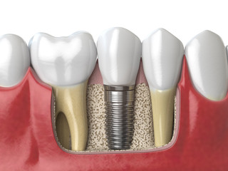 Anatomy of healthy teeth and tooth dental implant in human dentura. - obrazy, fototapety, plakaty