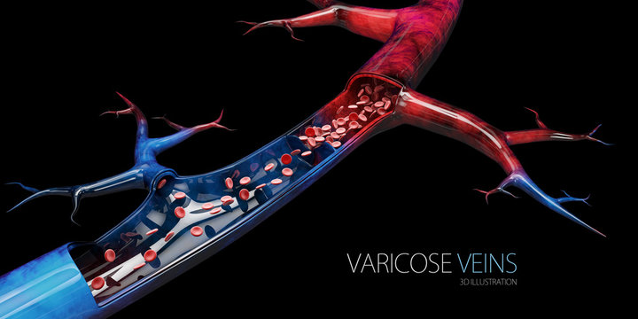 Disease varicose veins, 3d illustration isolated black.