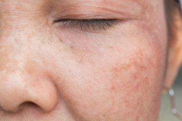 freckles on the  face